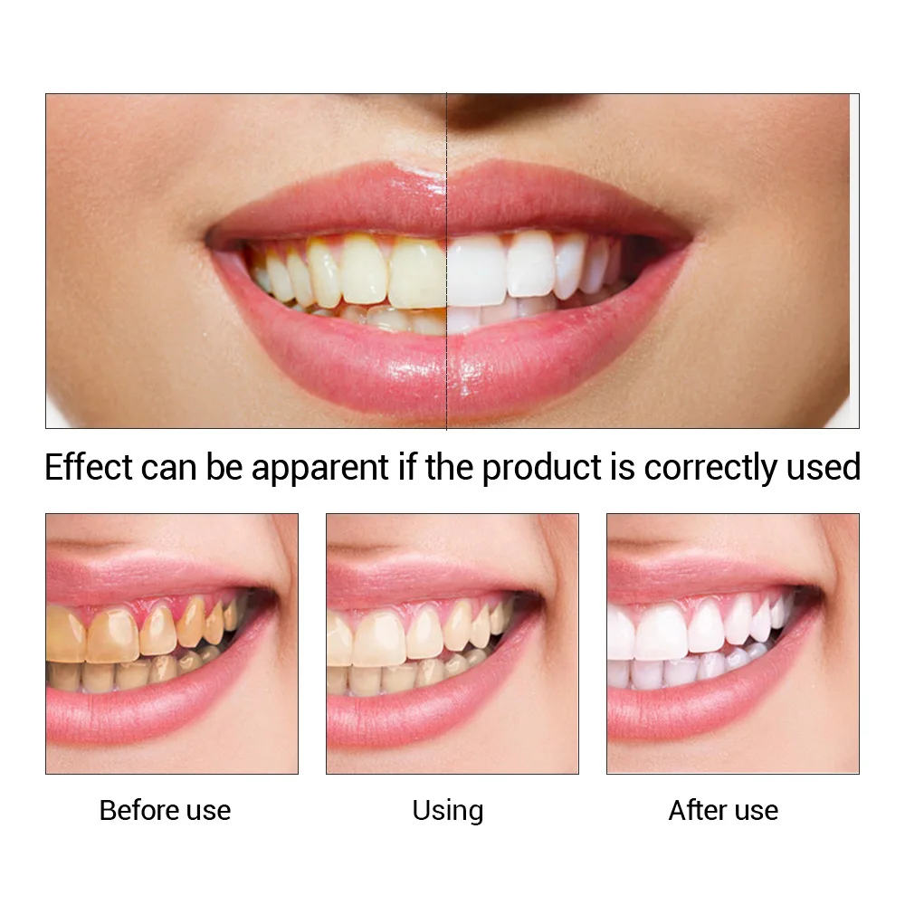 FTEENPLY Teeth Whitening Essen - огляд і ціна Teeth Whitening Bleach